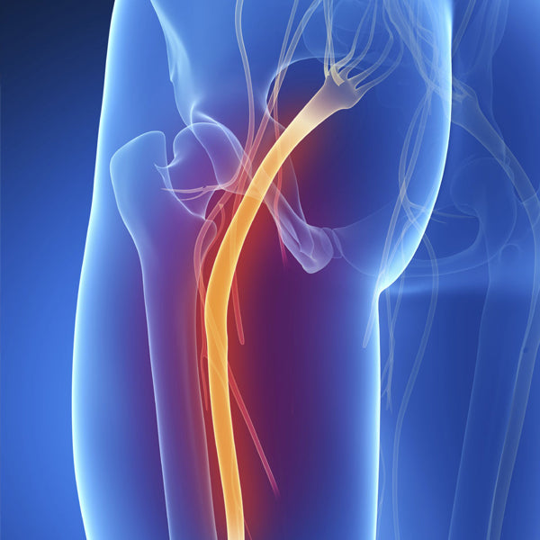 ¿Qué es y cuáles son las causas de Ciática?